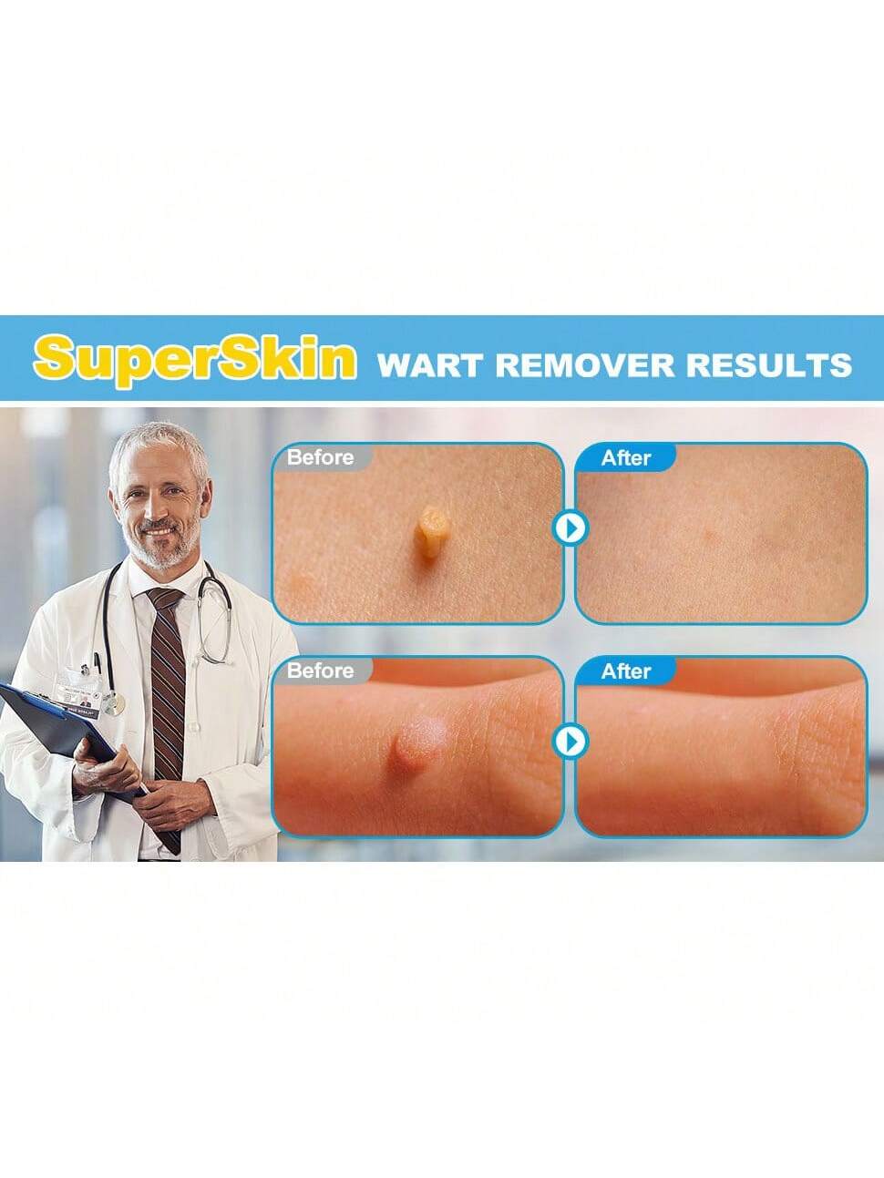 CHARMEEZ Skin Tag Removal Kit, 2-In-1 Effectively And Painless Skin Mole Tag Remover Set, Fast-Acting & Easy For Small To Large Sized Skin Tags Fall Off Device For All Body Parts (2mm-7mm)